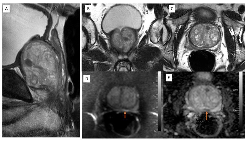 Figure Mri Prostate Pirads 2 A Statpearls Ncbi Bookshelf