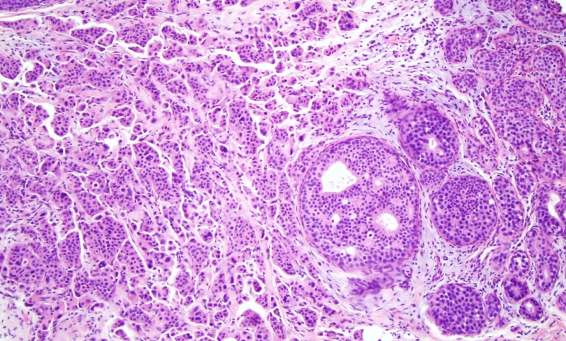 Invasive Ductal Carcinoma Histology