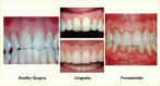 Image showing healthy gingiva, gingivitis, which is reversible inflammation, and periodontitis, a condition of irreversible damage of the soft and hard tissues surrounding the teeth.