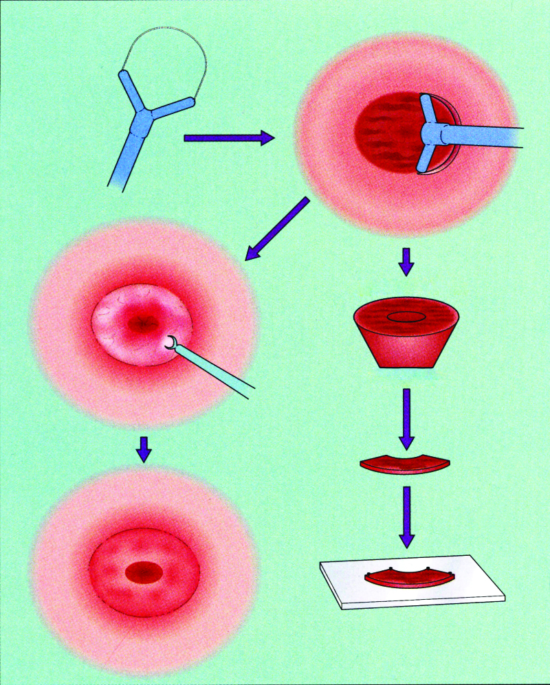 Colposcopic Terminology The 2011 Ifcpc Nomenclature Colposcopy And Treatment Of Cervical 5965