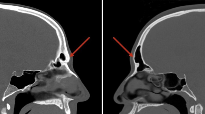 CT scans demonstrating different thicknesses of anterior tables of frontal sinuses; thickness of the bone may have a major impact on the surgical plan