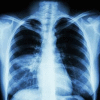 Ventilator-Associated Aspiration Pneumonia
