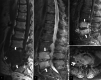 Fig. 15.5. A 70-year-old male patient with a history of 5 months of low back pain and a final diagnosis of tuberculous spondylodiscitis.