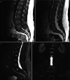 Fig. 14.11. (a) Sagittal T1-weighted MR image demonstrating Romanus lesions at L2 and T12 vertebral bodies, with low and high signal, respectively.