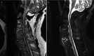 Fig. 14.13. (a) Sagittal T2-weighted MR image of cervical spine demonstrating multiple levels of bone fusion by AS from C3 to C6 with ossification demonstrated as low signal at disc space and spinal stenosis at C3–C4.