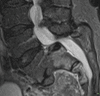 Fig. 14.8. Severe spondylolisthesis with surgical fusion.