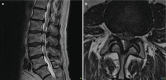 Fig. 14.9. (a) MRI spinal stenosis.