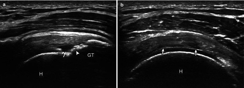 Fig Supraspinatus Tear Articular Side Partial Thickness