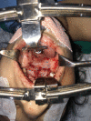 Operative view of Furlow repair of patient in Figure 1: incomplete cleft palate involving hard and soft palate