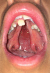 Adolescent patient with an isolated cleft palate involving the hard and soft palate