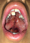 Adolescent patient with an isolated cleft palate involving the hard and soft palate
