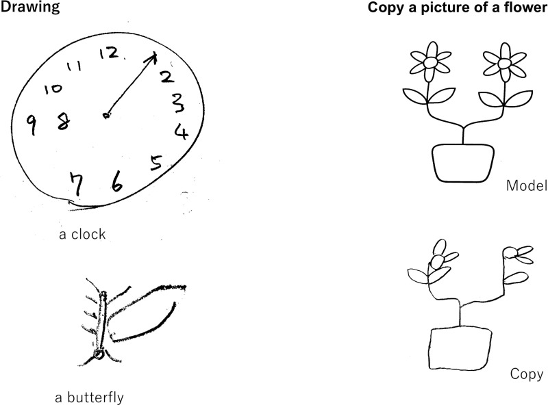 Unilateral Spatial Neglect Due to Stroke Stroke NCBI Bookshelf