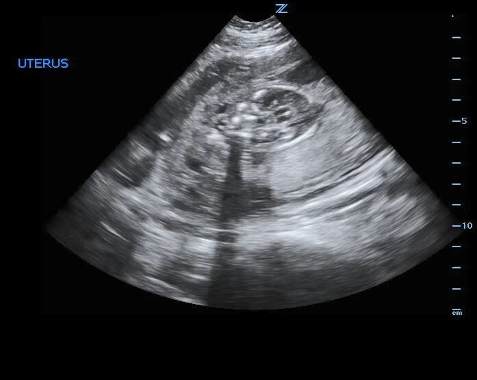 Figure Third Trimester Pregnancy Ultrasound With Statpearls Ncbi Bookshelf 6329