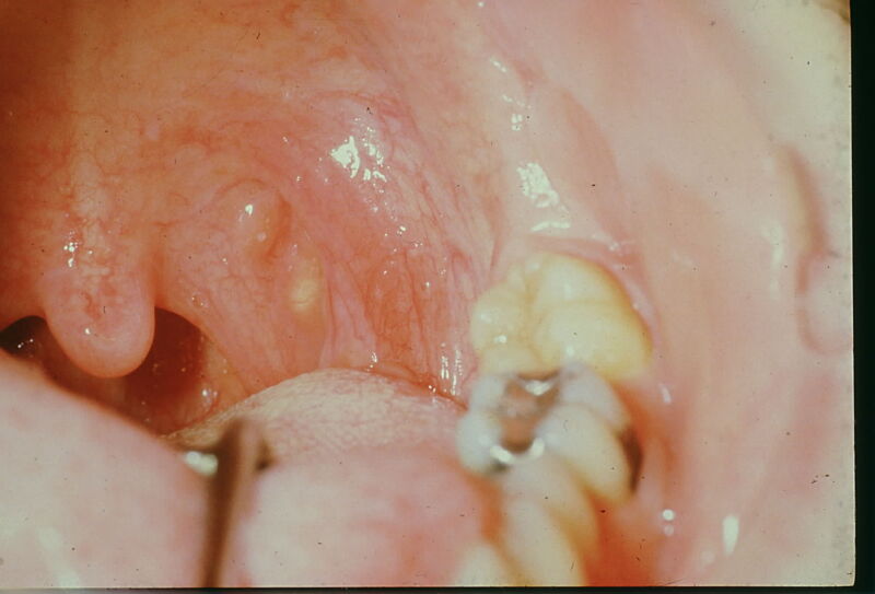 Figure Oral Lymph Epithelial Cyst And Aggregate Statpearls Ncbi Bookshelf 4478