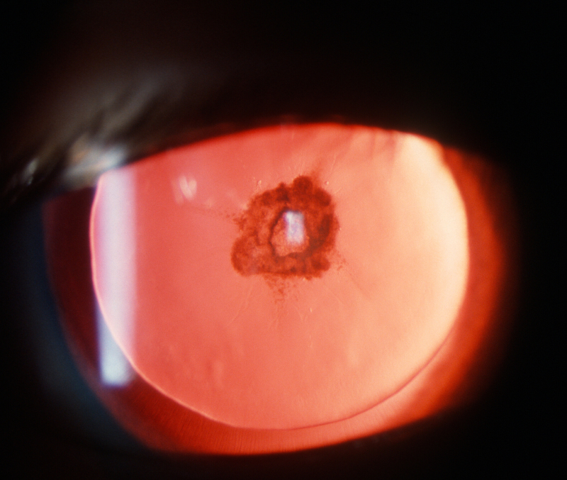 posterior subcapsular cataract