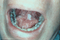 Image of the floor of the mouth with leukoplakia