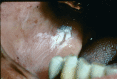 Photo of buccal vestibule exhibiting hyperkeratosis from smokeless tobacco