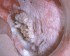 Photo of buccal vestibule exhibiting hyperkeratosis and verrucous carcinoma