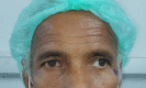 Image of the patient depicting 20 degree exotropia along with 10 degree hypertropia in the left eye in primary gaze