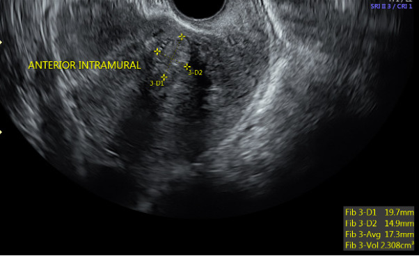 uterus fibroids ultrasound