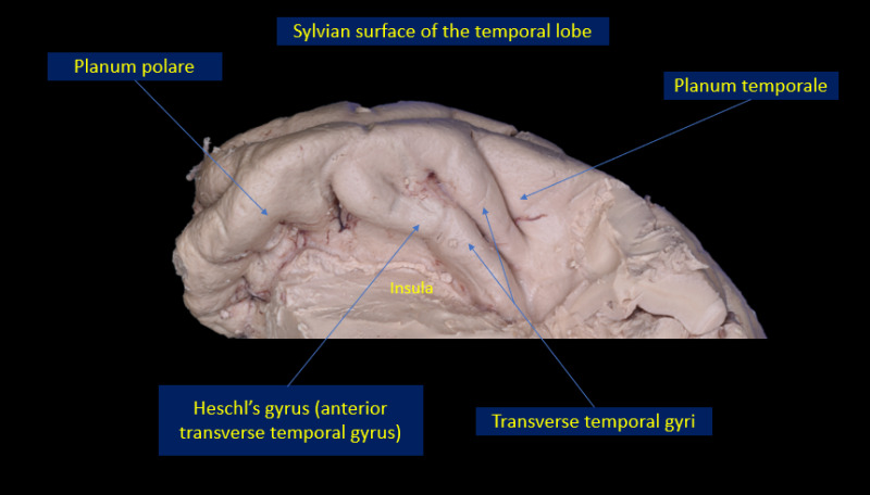sylvian fissure anatomy