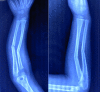 X-ray of right forearm anteroposterior and lateral view in a five-year-old child showing middle-third both bone fracture