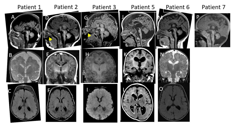 Setd2 Neurodevelopmental Disorders Genereviews® Ncbi Bookshelf 3273