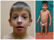 Figure 4. . Craniofacial characteristics in an individual with a 3p21.