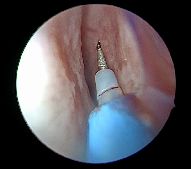 Figure, Rotator cuff tear Image courtesy S Bhimji MD] - StatPearls - NCBI  Bookshelf