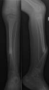 X-ray showing congenital tibial pseudarthrosis