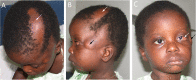 Figure 2. . Linear alopecia (white arrows in A and B) and choristoma (C) in an affected individual age 2.