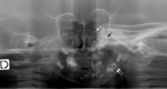 Figure 5. . Panoramic radiographs of an affected individual showing hypoplasia of the left maxillary sinus (single white arrow), a bulky mass of dentine structures consistent with left maxillary odontomas (black arrow), and a solitary odontoma of the left lower jaw incorporating misshaped dental structures (double white arrows).