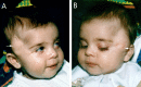 Figure 7. . An affected individual age 5 months.
