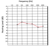 Audiogram showing severe hearing loss Contributed by Josiah Brandt