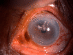 Slit lamp image of the patient depicting conjunctival congestion, superior two clock hour iridodialysis, iris chaffing and haptic of IOL extruding through the iridodialysis area Contributed by Dr