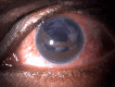 Slit lamp image of the patient depicting large traumatic iridodialysis from 10 o'clock to 3 o'clock, correctopia, ectopic pupil, and fibrosed capsular remnants Contributed by Dr