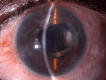 Slit lamp image of the patient post nasal iridodialysis repair by McCannel technique Contributed by Dr