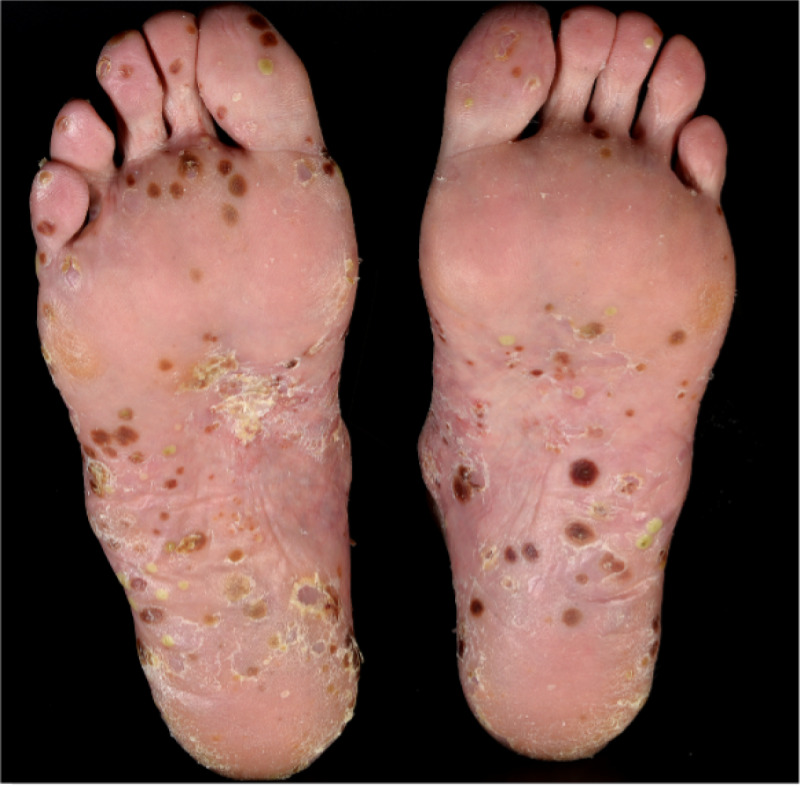 FIGURE 21. Study photograph taken of one participant’s soles.