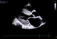 Figure 2 - The parasternal long-axis view of a transthoracic echocardiogram shows a thickened bright myocardium, which is often the first clue towards the diagnosis of cardiac amyloidosis