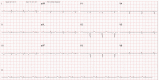 A 12-lead electrocardiogram of a patient with cardiac amyloidosis