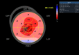 Figure 3 - The global longitudinal strain of a patient with cardiac amyloidosis, showing the typical 'cherry red spot' on a bull's eye map