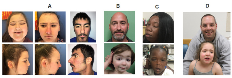 Beckwith-Wiedemann Syndrome - GeneReviews® - NCBI Bookshelf