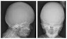 Figure 2. . Skull radiographs from the same child at age two weeks.