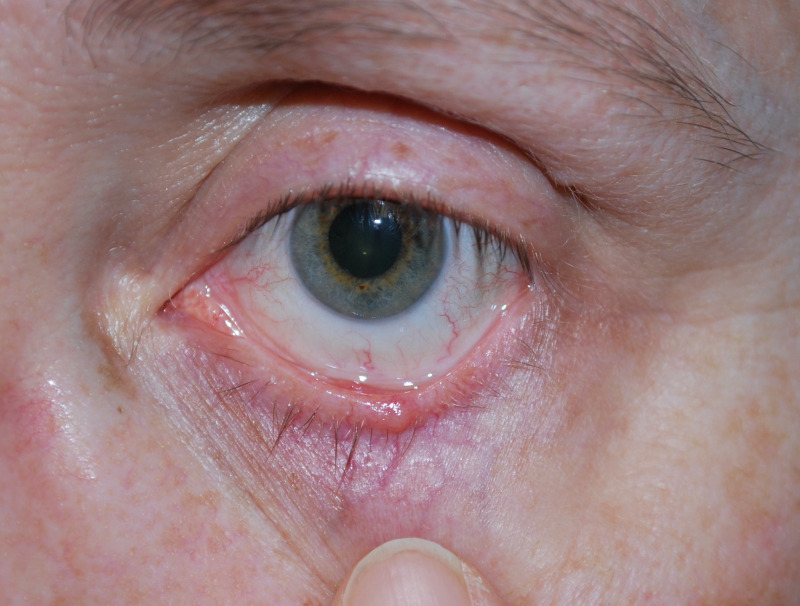 [Figure, Basal Cell Carcinoma of the left lower eyelid Contributed by ...