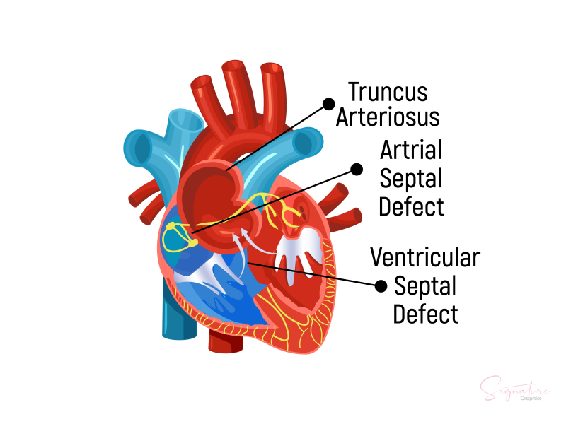 atrial septal defect