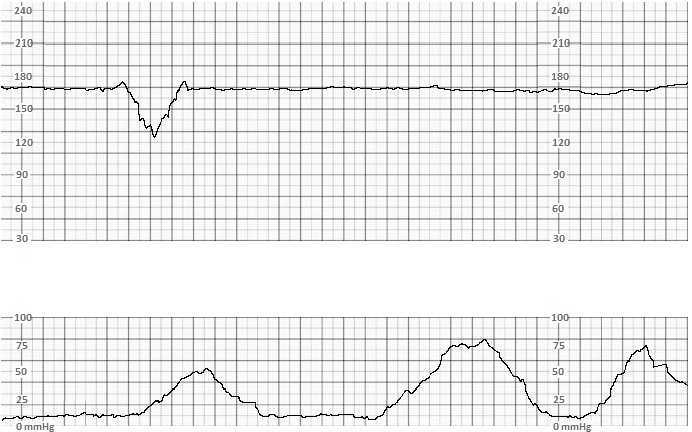 Fetal Monitoring Statpearls Ncbi Bookshelf 