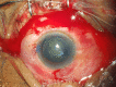 Traumatic Cataract