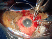 Traumatic Cataract Repair