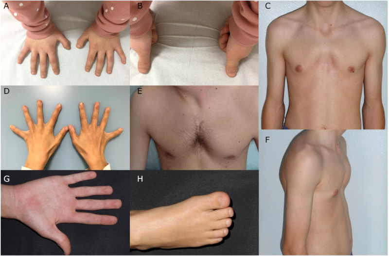 Figure 2. [Dorsal (A) and palmar (B)]. - GeneReviews® - NCBI Bookshelf