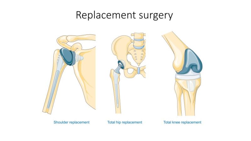 Figure 13.15 Joint Replacement . Nursing Skills NCBI Bookshelf